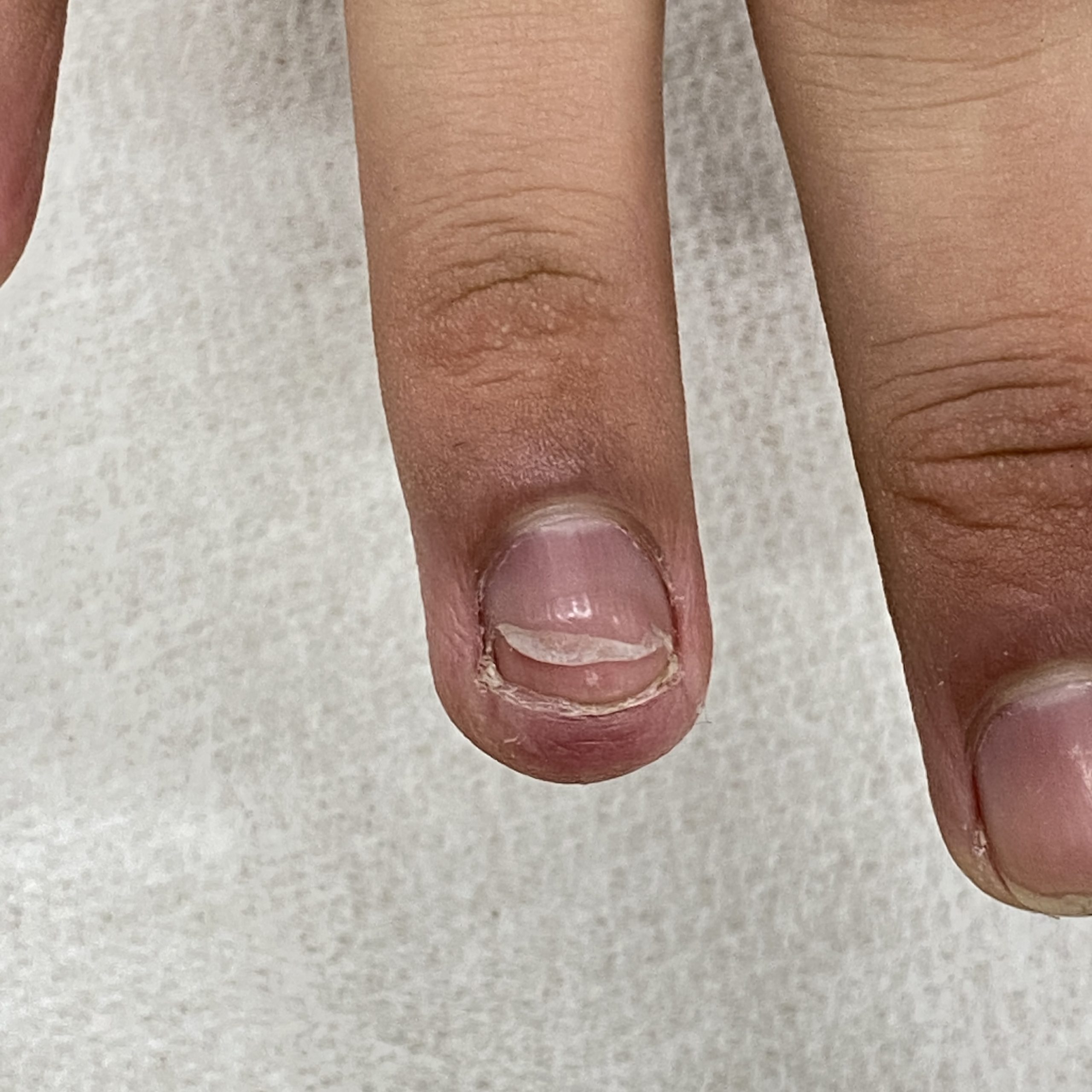 アスリートの爪 割れて短くなってもジェルなどで長さを足さないこと